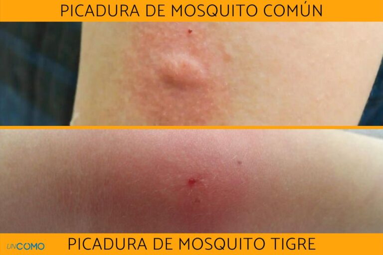 Cómo reconocer una reacción alérgica a una picadura de mosquito Tigre?