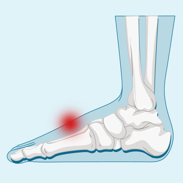 ¿Cómo tratar la tendinitis en el pie empeine?