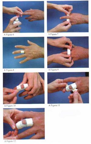 Cuál es el vendaje más adecuado para un esguince de dedo de la mano?