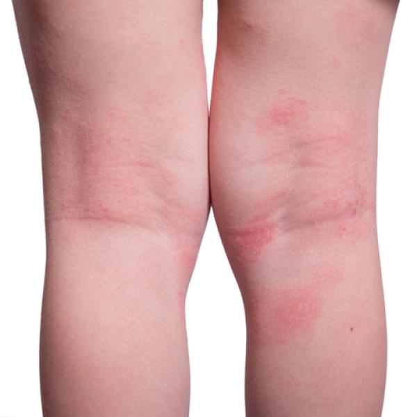 Pregunta: ¿Qué son las manchas rojas en las piernas?